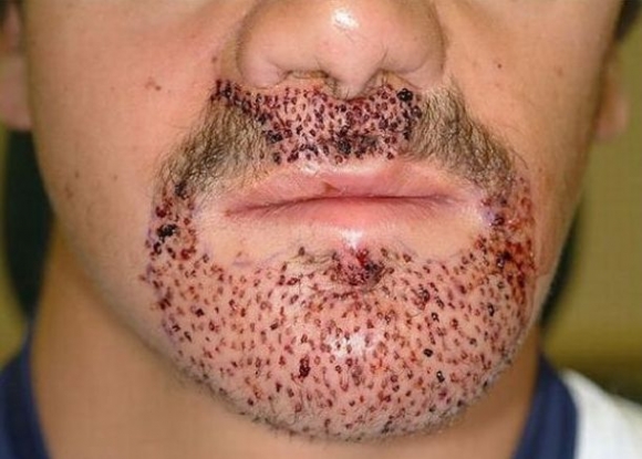 Ha már túl vagy a herevasaláson